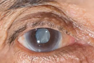 CATARACT SURGERY