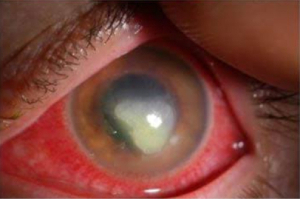 Corneal Infection and Ulcer