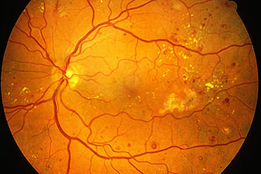 DIABETIC RETINOPATHY