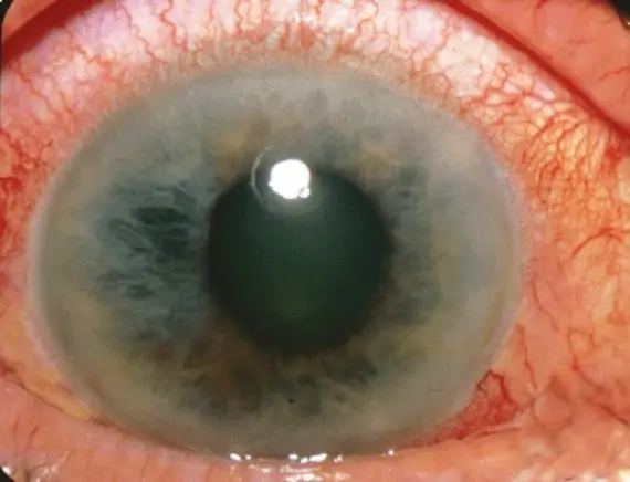 glaucoma-eye-treatment