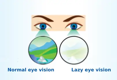 Vision Therapy, Lazy Eye Treatment, Amblyopia