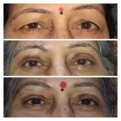 Bilateral Brow Ptosis