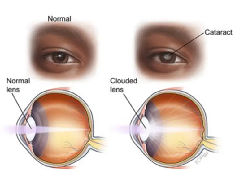 cataract-illustration
