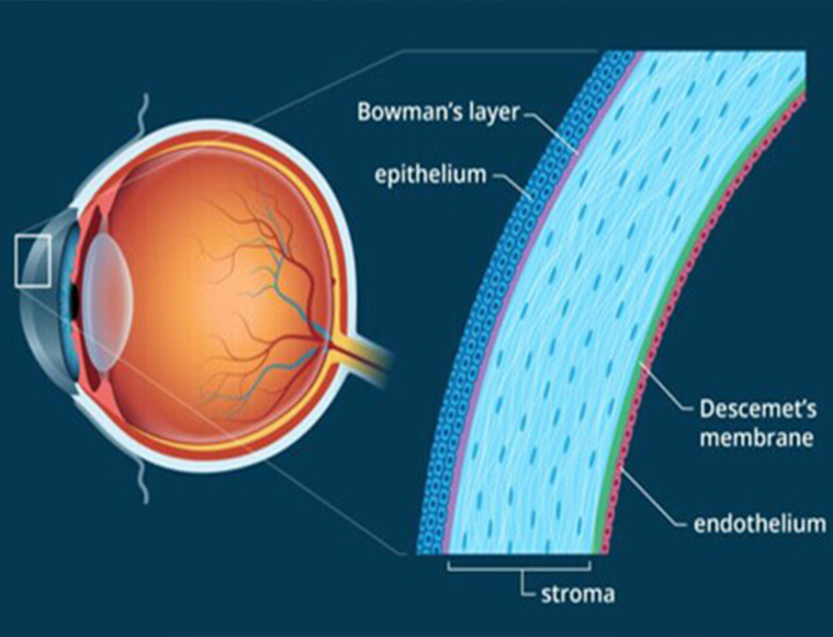 cornea-treatment